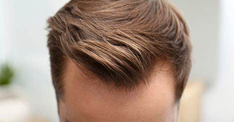 Caduta dei capelli: cause, prevenzione e rimedi naturali efficaci per contrastarla