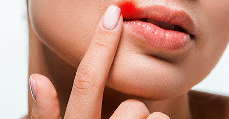 Herpes labiale, genitale e zoster: cause, sintomi e soluzioni naturali efficaci